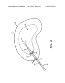 Apparatus for Delivery of Therapeutic Material to an Intervertebral Disc and Method of Use diagram and image