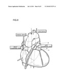 RADIOFREQUENCY THERMAL BALLOON CATHETER SYSTEM diagram and image