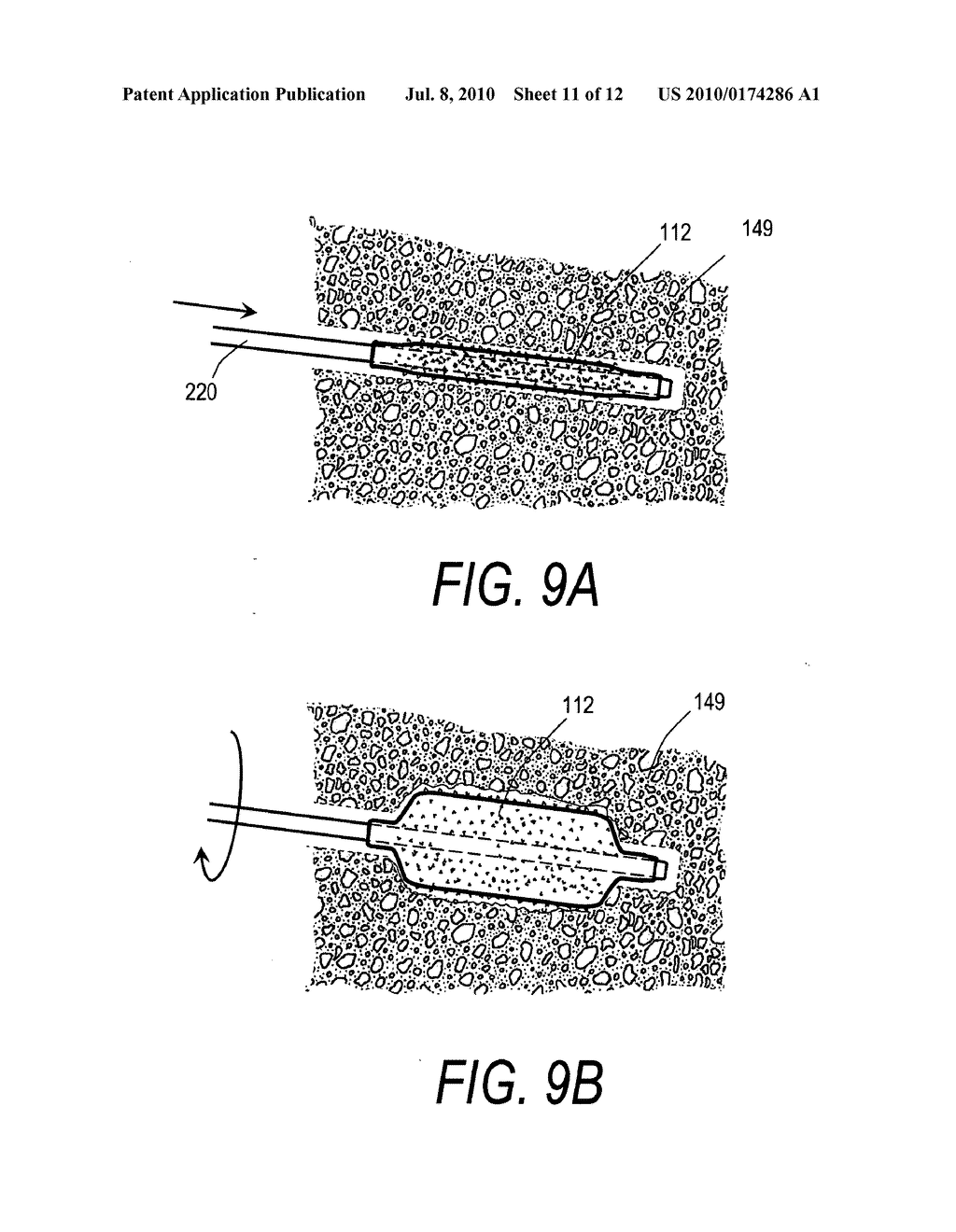 BONE TREATMENT SYSTEMS AND METHODS FOR INTRODUCING AN ABRADING STRUCTURE TO ABRADE BONE - diagram, schematic, and image 12