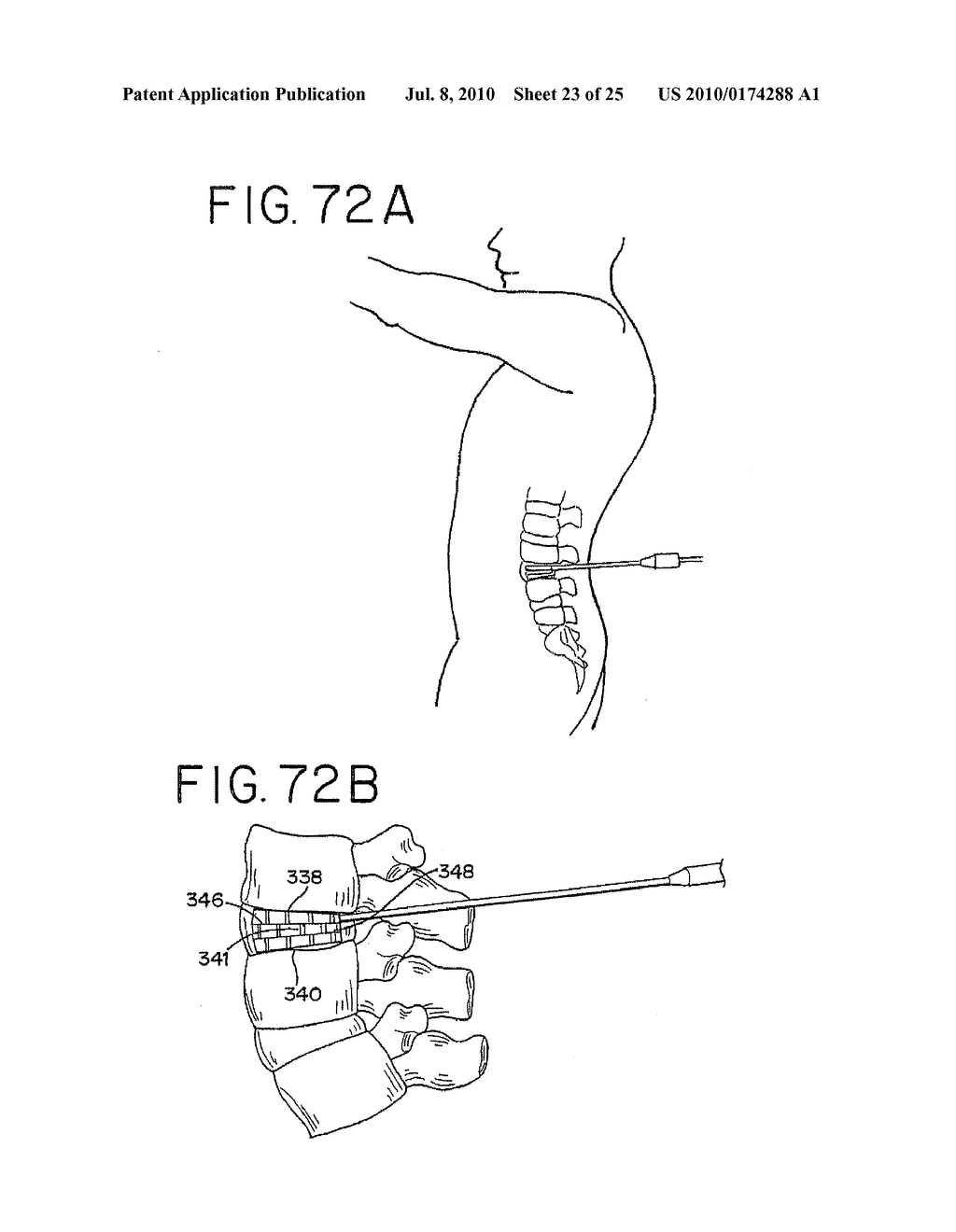 Methods for Limiting the Movement of Material Introduced Between Layers of Spinal Tissue - diagram, schematic, and image 24