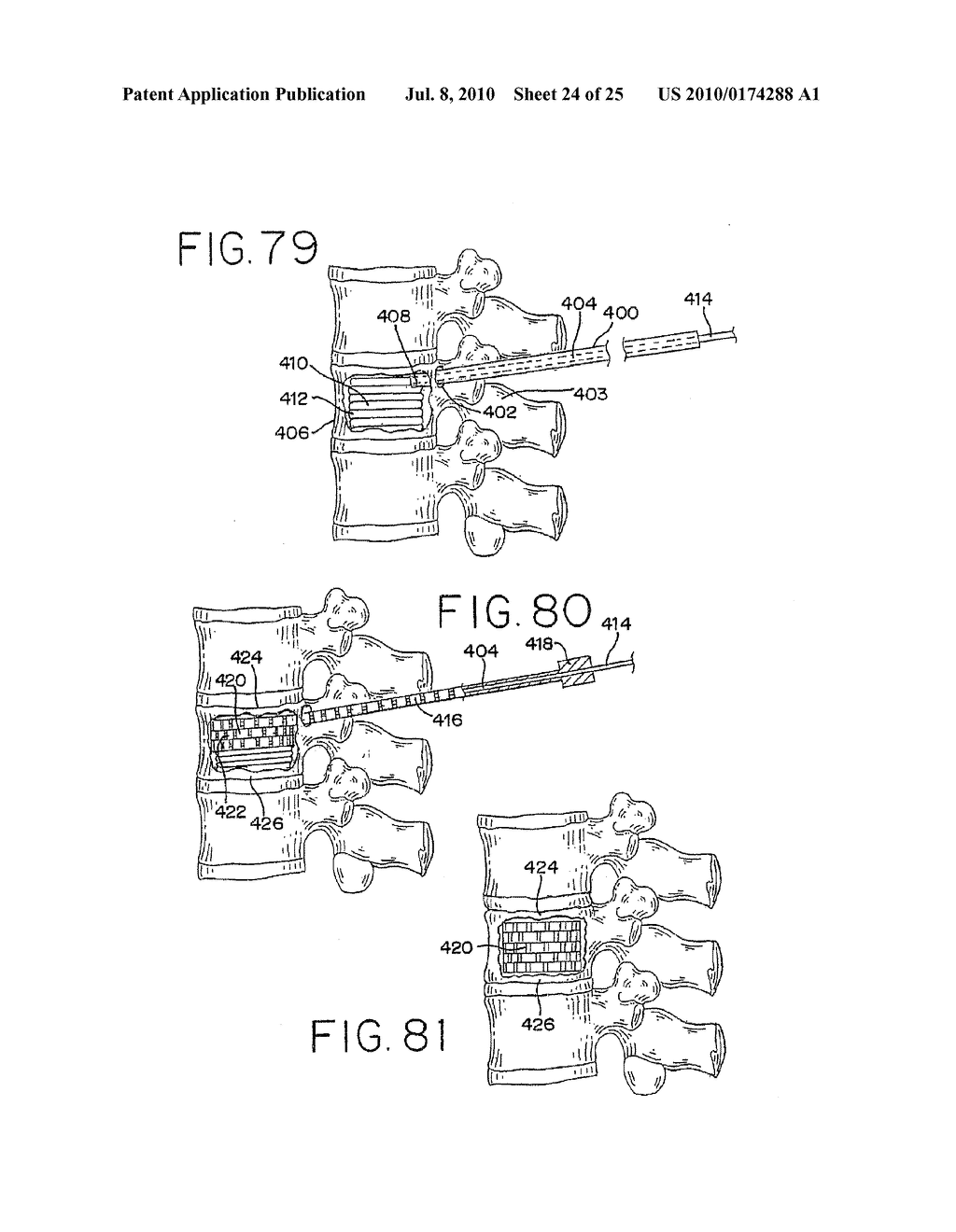 Methods for Limiting the Movement of Material Introduced Between Layers of Spinal Tissue - diagram, schematic, and image 25