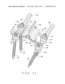 DEVICE FOR SPINAL FUSION diagram and image