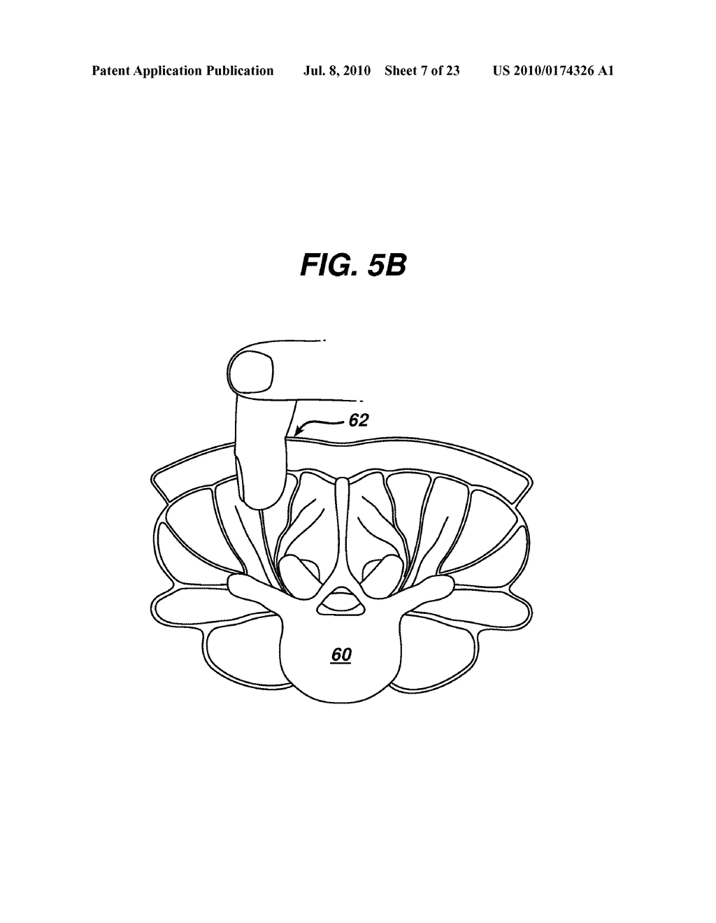 METHODS AND DEVICES FOR MINIMALLY INVASIVE SPINAL FIXATION ELEMENT PLACEMENT - diagram, schematic, and image 08