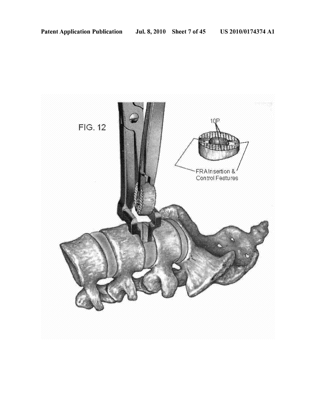 DYNAMIC SPINAL IMPLANTS INCORPORATING CARTILAGE BEARING GRAFT MATERIAL - diagram, schematic, and image 08