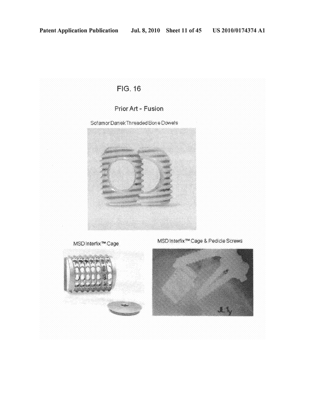 DYNAMIC SPINAL IMPLANTS INCORPORATING CARTILAGE BEARING GRAFT MATERIAL - diagram, schematic, and image 12