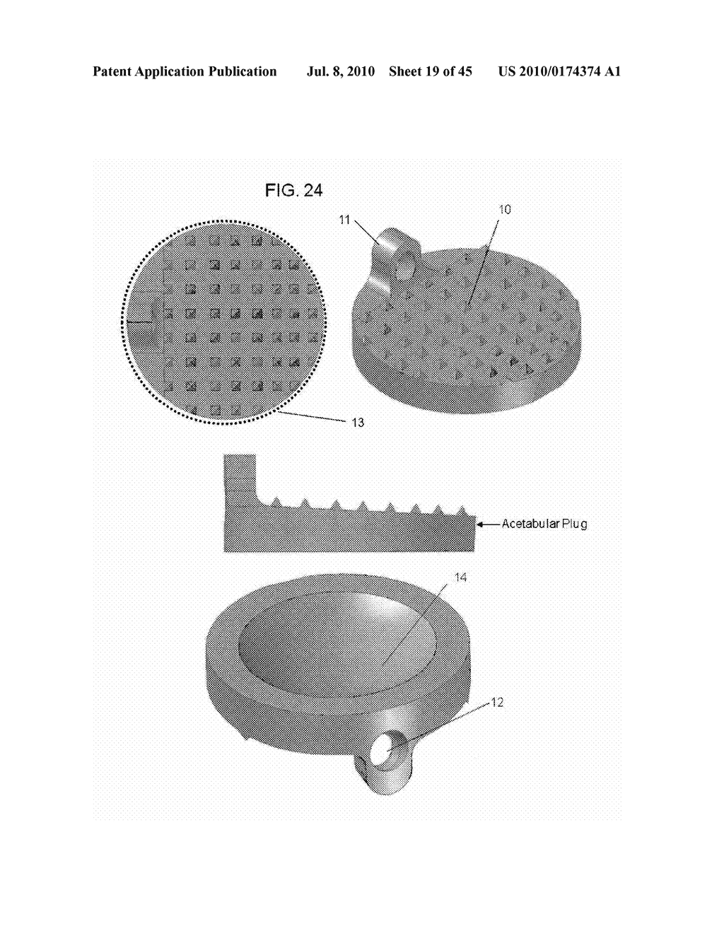 DYNAMIC SPINAL IMPLANTS INCORPORATING CARTILAGE BEARING GRAFT MATERIAL - diagram, schematic, and image 20