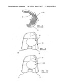 KNEE PROSTHESES diagram and image