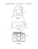 KNEE PROSTHESES diagram and image