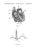 RAPID METHOD FOR ANALYZING BIO-SIGNAL INSTANTANEOUSLY BY PHASE SPACE COMPLEXITY DIFFERENCE AND ITS DEVICE diagram and image