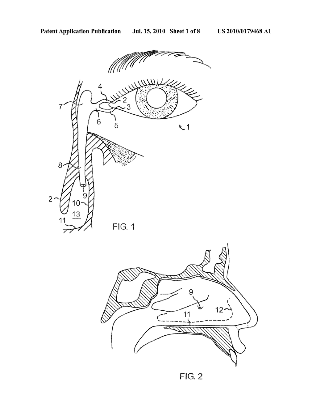 Side-by-side lacrimal intubation threader and method - diagram, schematic, and image 02
