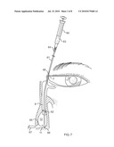 Side-by-side lacrimal intubation threader and method diagram and image