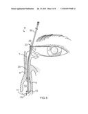 Side-by-side lacrimal intubation threader and method diagram and image