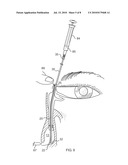 Side-by-side lacrimal intubation threader and method diagram and image