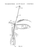 Side-by-side lacrimal intubation threader and method diagram and image