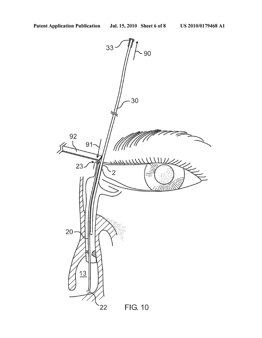Side-by-side lacrimal intubation threader and method - diagram, schematic, and image 07