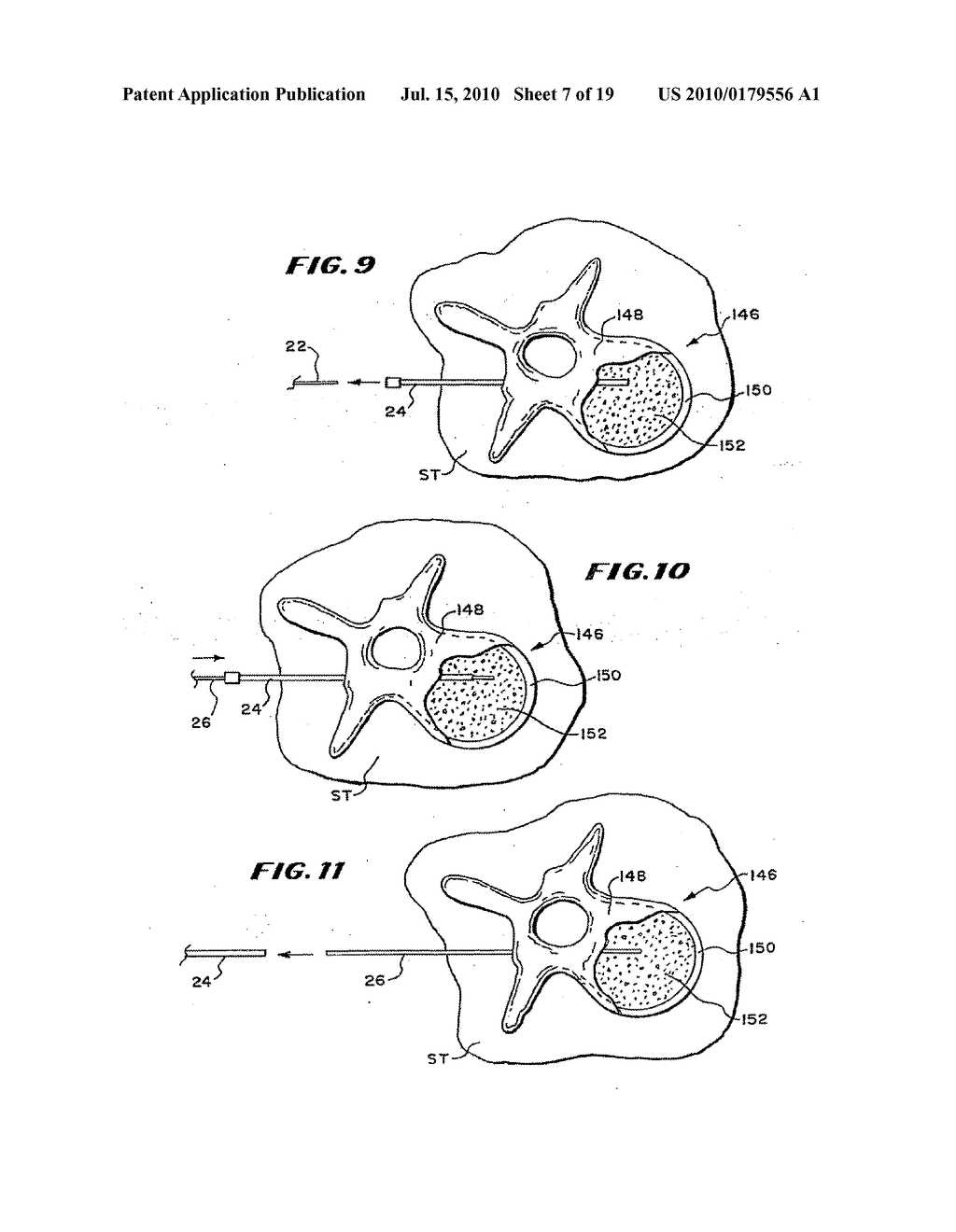 METHODS FOR PLACING MATERIALS INTO BONE - diagram, schematic, and image 08