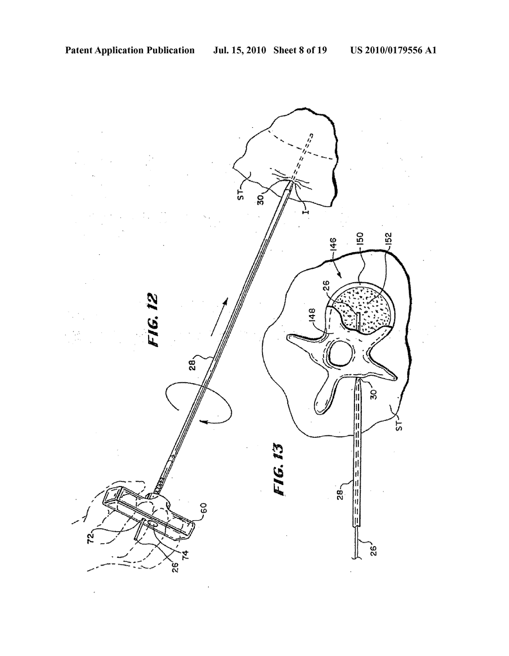 METHODS FOR PLACING MATERIALS INTO BONE - diagram, schematic, and image 09