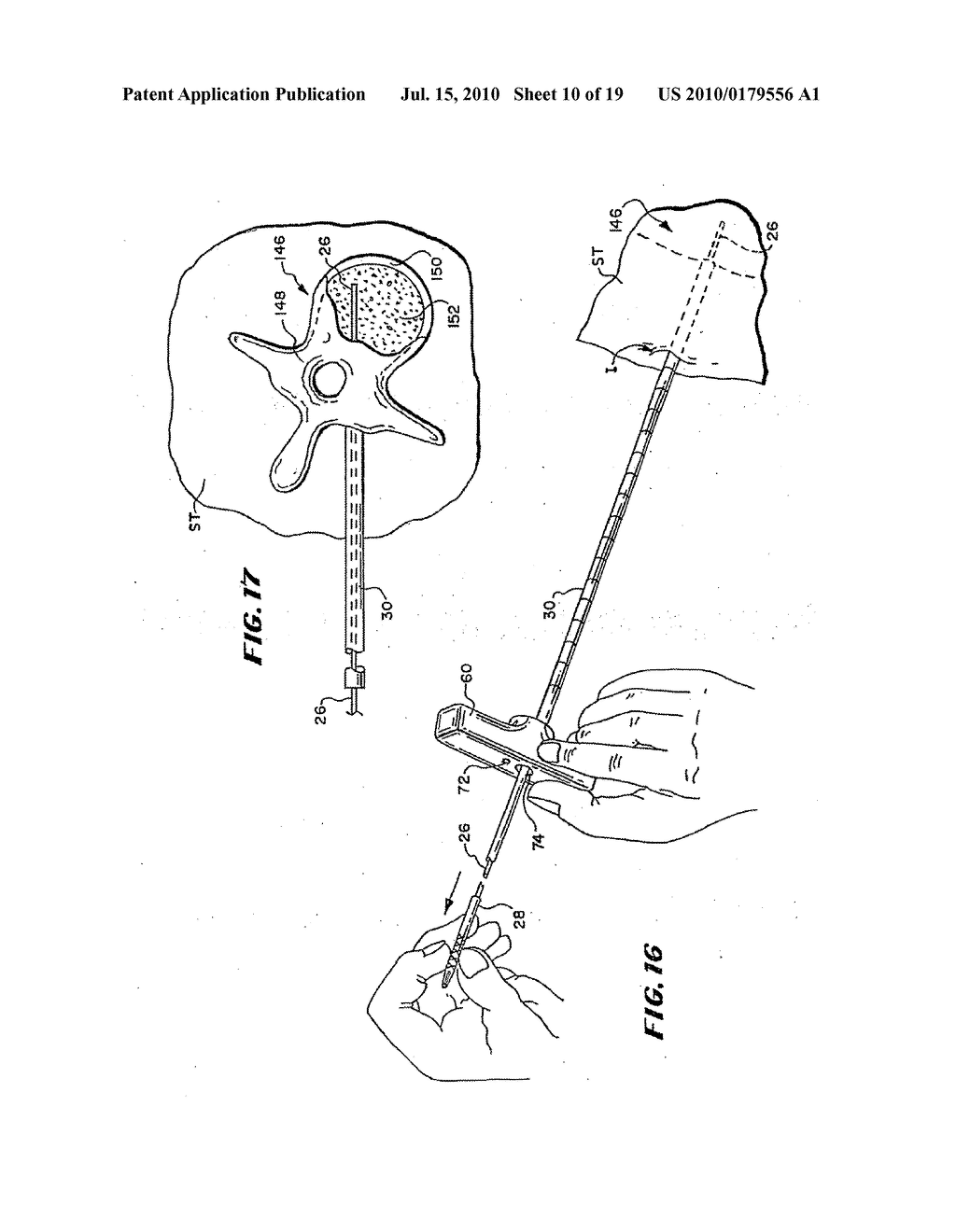 METHODS FOR PLACING MATERIALS INTO BONE - diagram, schematic, and image 11