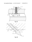 CLOSURE DEVICES, SYSTEMS, AND METHODS diagram and image