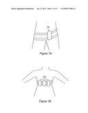 Device For Control of Difficult to Compress Hemorrhage diagram and image