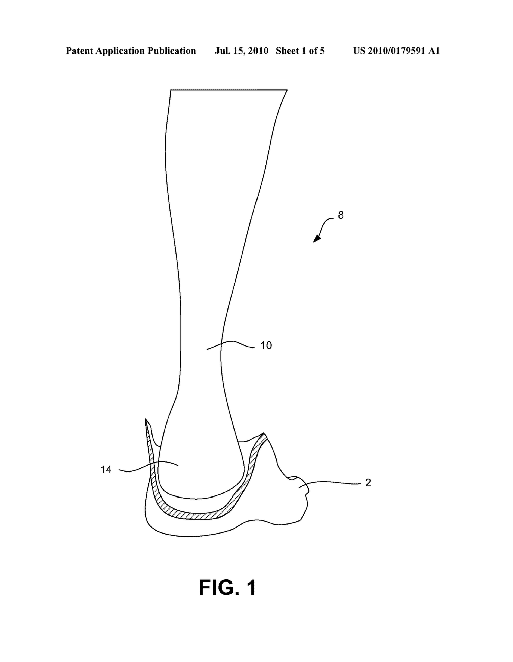 PATCH AUGMENTATION OF ACHILLES TENDON REPAIRS - diagram, schematic, and image 02