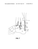 PATCH AUGMENTATION OF ACHILLES TENDON REPAIRS diagram and image