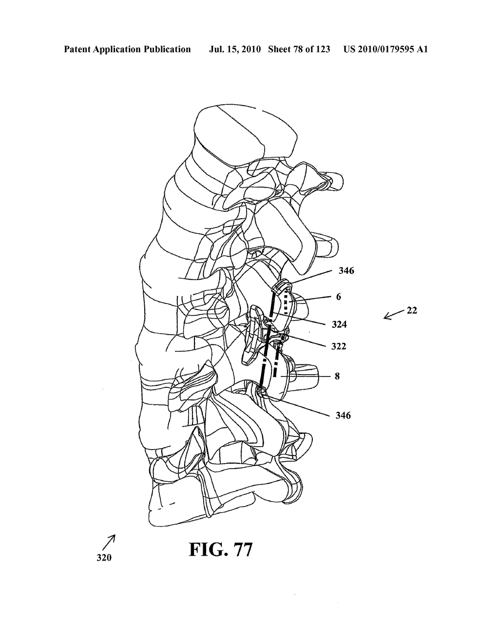 Intervertebral Implant Devices and Methods for Insertion Thereof - diagram, schematic, and image 79