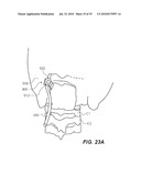 CRANIOSPINAL FUSION METHOD AND APPARATUS diagram and image