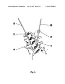 METHOD FOR LOCKING AN ARTIFICIAL FACET BETWEEN TWO VERTEBRAL BODIES diagram and image