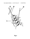 METHOD FOR LOCKING AN ARTIFICIAL FACET BETWEEN TWO VERTEBRAL BODIES diagram and image