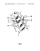 METHOD FOR LOCKING AN ARTIFICIAL FACET BETWEEN TWO VERTEBRAL BODIES diagram and image