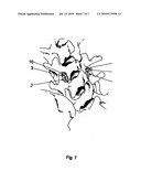 METHOD FOR LOCKING AN ARTIFICIAL FACET BETWEEN TWO VERTEBRAL BODIES diagram and image