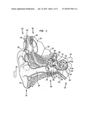 IMPLANTABLE ACOUSTIC SENSOR diagram and image