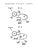 IMPLANTABLE ACOUSTIC SENSOR diagram and image