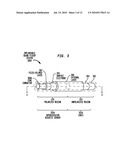 IMPLANTABLE ACOUSTIC SENSOR diagram and image