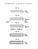 IMPLANTABLE ACOUSTIC SENSOR diagram and image