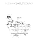 IMPLANTABLE ACOUSTIC SENSOR diagram and image