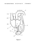 HEART ASSIST DEVICE, CANNULA AND FILTER THEREFOR diagram and image