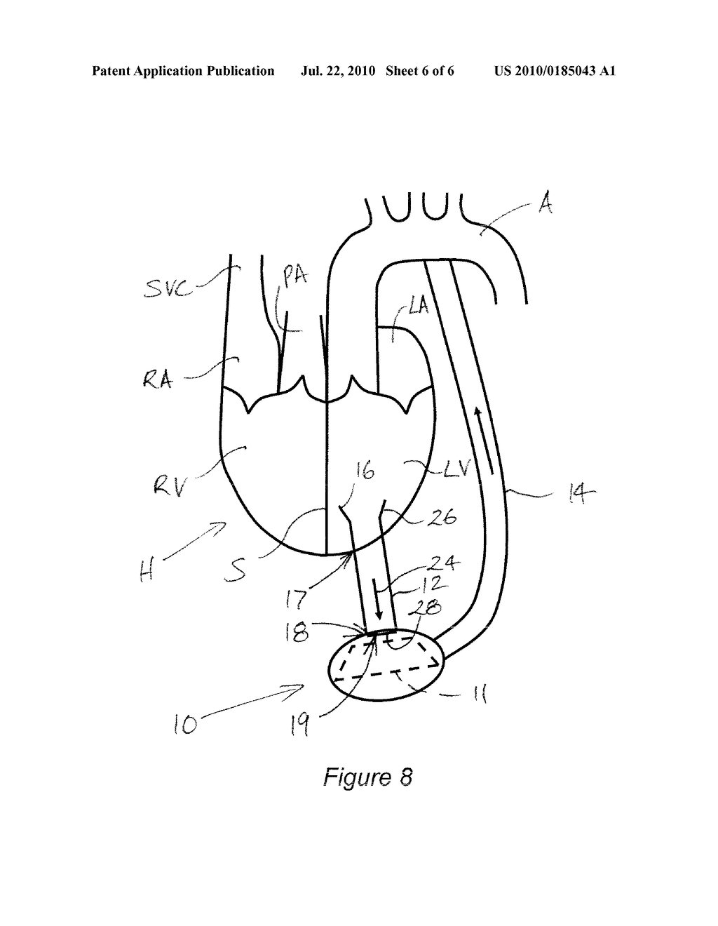 HEART ASSIST DEVICE, CANNULA AND FILTER THEREFOR - diagram, schematic, and image 07