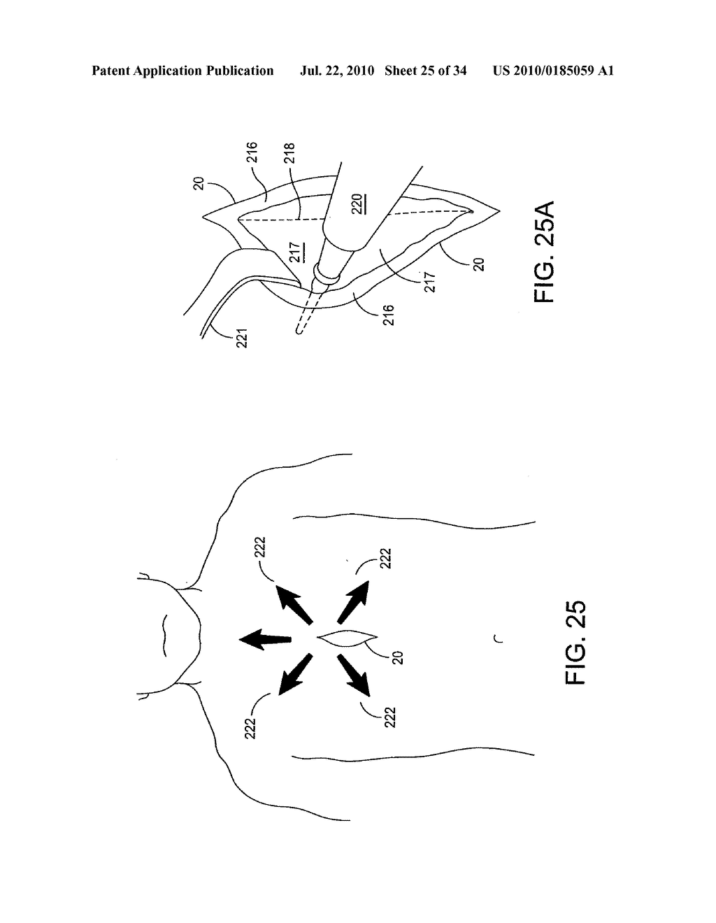 METHODS AND APPARATUS FOR PERFORMING MINIMALLY INVASIVE SURGERY - diagram, schematic, and image 26