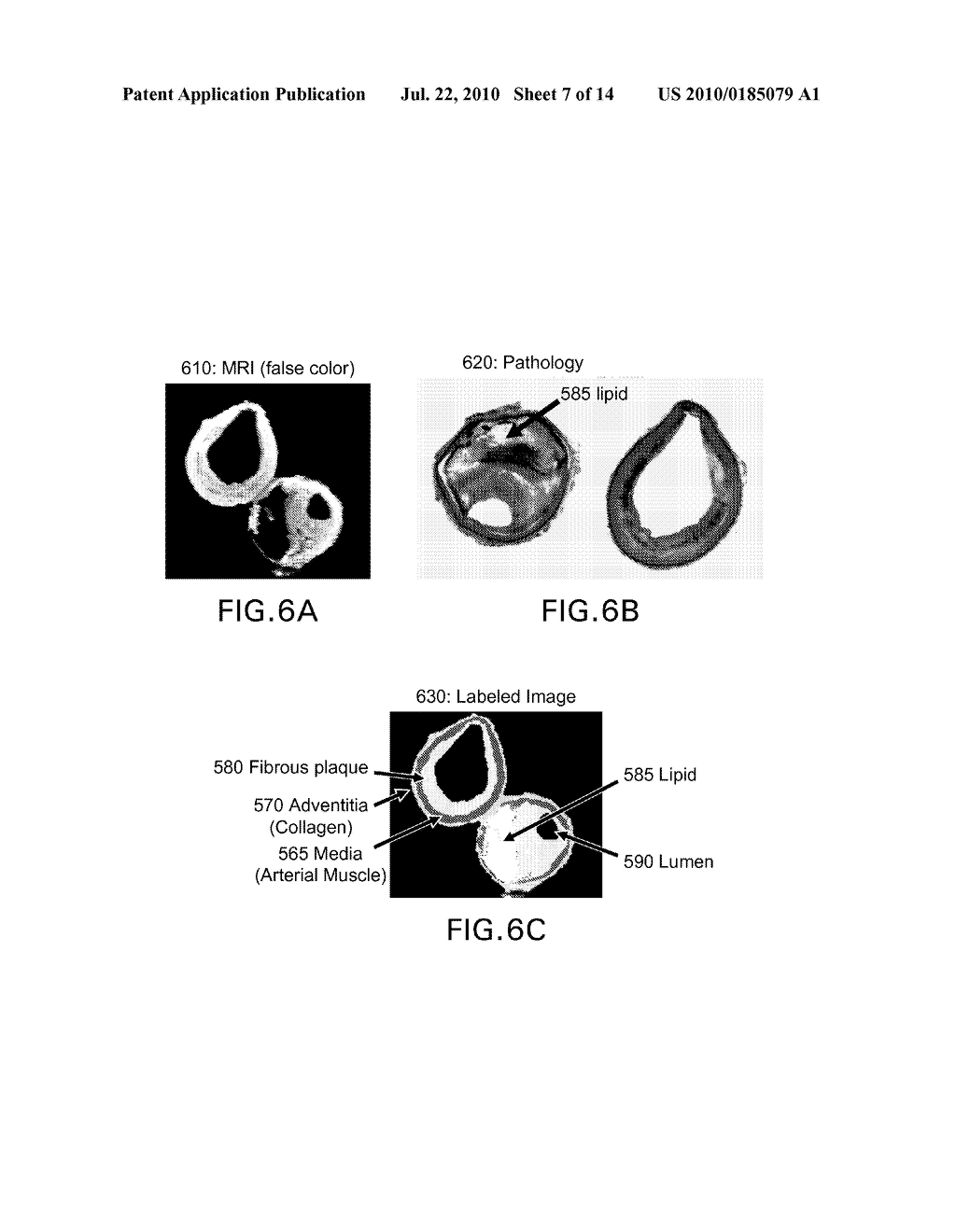 AUTOMATED METHODS AND SYSTEMS FOR VASCULAR PLAQUE DETECTION AND ANALYSIS - diagram, schematic, and image 08