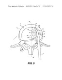 SPINAL ASPIRATION APPARATUS diagram and image