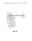 SPINAL ASPIRATION APPARATUS diagram and image