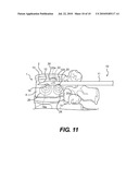 SPINAL ASPIRATION APPARATUS diagram and image