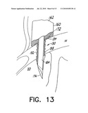 FLOW REGULATING IMPLANT, METHOD OF MANUFACTURE, AND DELIVERY DEVICE diagram and image