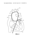 DIAGNOSTIC CATHETERS, GUIDE CATHETERS, VISUALIZATION DEVICES AND CHORD MANIPULATION DEVICES, AND RELATED KITS AND METHODS diagram and image