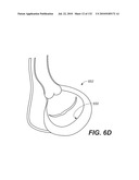 DIAGNOSTIC CATHETERS, GUIDE CATHETERS, VISUALIZATION DEVICES AND CHORD MANIPULATION DEVICES, AND RELATED KITS AND METHODS diagram and image