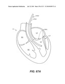 DIAGNOSTIC CATHETERS, GUIDE CATHETERS, VISUALIZATION DEVICES AND CHORD MANIPULATION DEVICES, AND RELATED KITS AND METHODS diagram and image