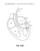 DIAGNOSTIC CATHETERS, GUIDE CATHETERS, VISUALIZATION DEVICES AND CHORD MANIPULATION DEVICES, AND RELATED KITS AND METHODS diagram and image