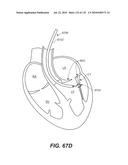 DIAGNOSTIC CATHETERS, GUIDE CATHETERS, VISUALIZATION DEVICES AND CHORD MANIPULATION DEVICES, AND RELATED KITS AND METHODS diagram and image